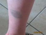 I woke up to find this bruise two days ago. It is on the inside of my leg.
